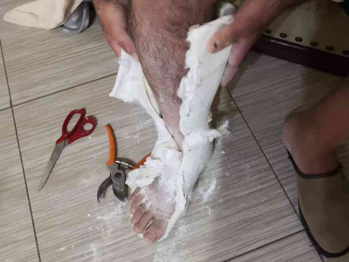 Immagine articolo: “Paura del COVID in Ospedale, il gesso me lo tolgo da solo“. A Santa Margherita imprenditore preferisce il “fai da te“